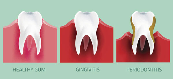 Gum Disease picture